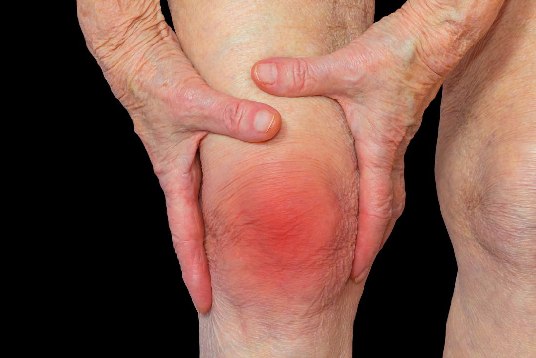 Rheumatoid arthritis in knee